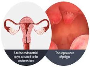 Polyp of Uterus KNOW MORE
