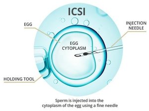 Intracyto Plasmic Sperm Injection(ICSI)  KNOW MORE