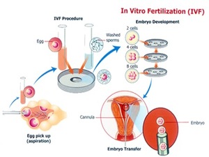 In Vitro Fertilization (IVF)  KNOW MORE