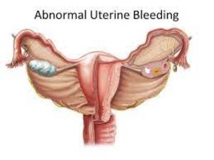 Abnormal Bleeding KNOW MORE