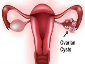 Ovarian Cyst KNOW MORE