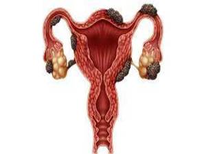 Endometriosis KNOW MORE
