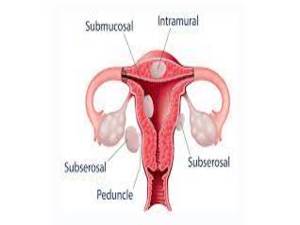 Fibroids KNOW MORE