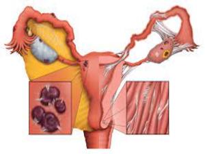 Pelvic Adhesions KNOW MORE